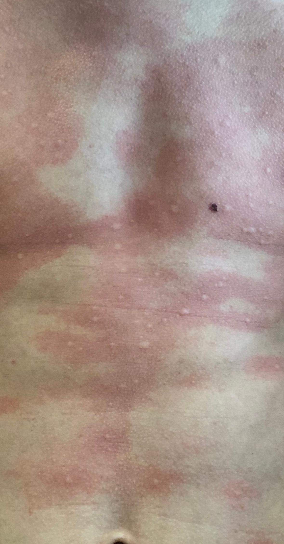 Haut Juckt Nach Sonne Ohne Ausschlag