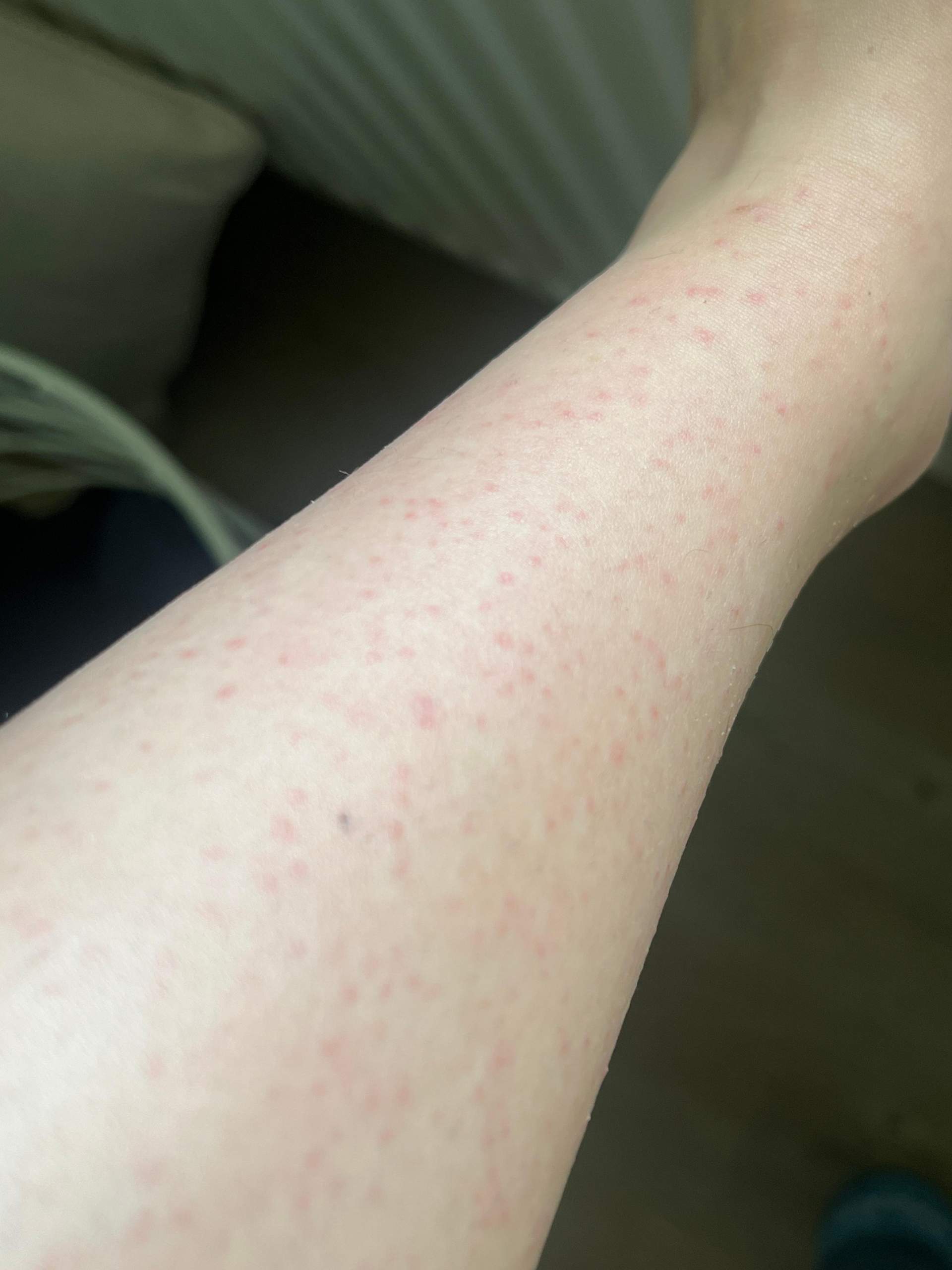 Ausschlag nach deme epilieren? (Gesundheit, Frauen, Körper)