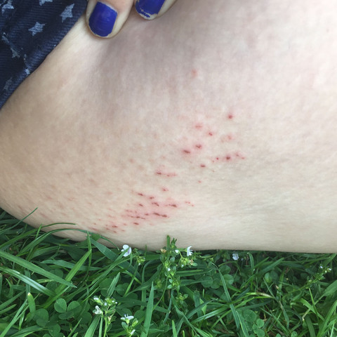 Ausschlag Nach Laufen Haut Gewicht Oberschenkel Ausschlag Nach Laufen Haut Gewicht Oberschenkel