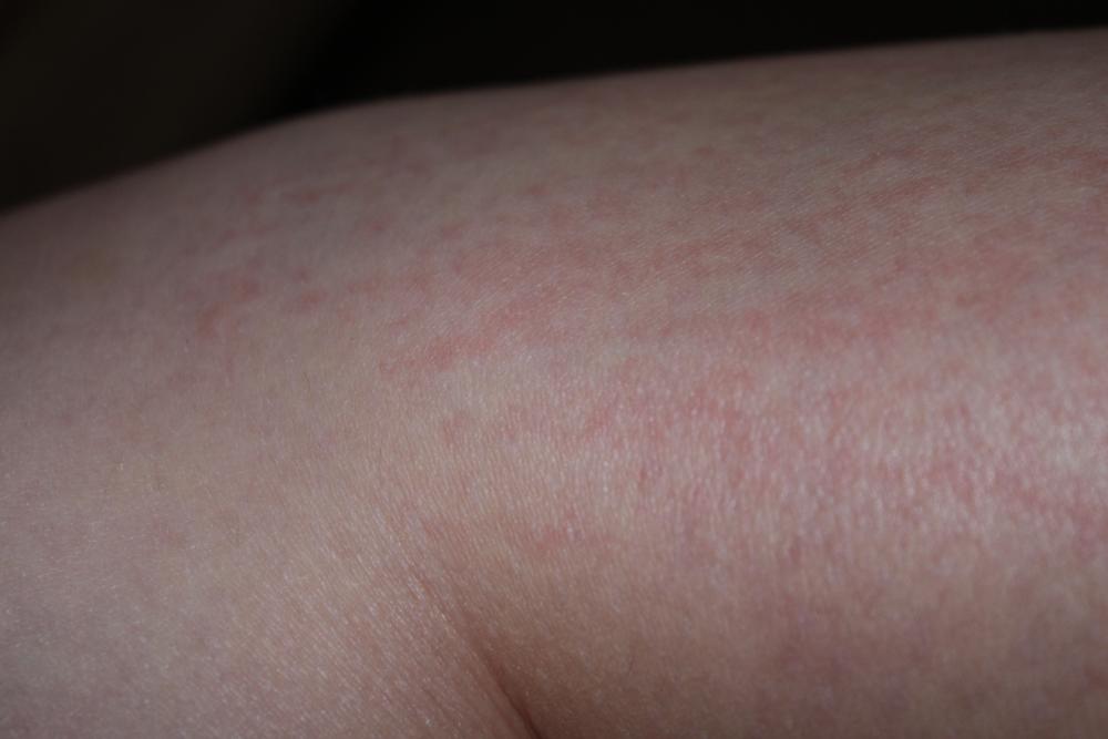 Ausschlag Nach Solarium Was Tun