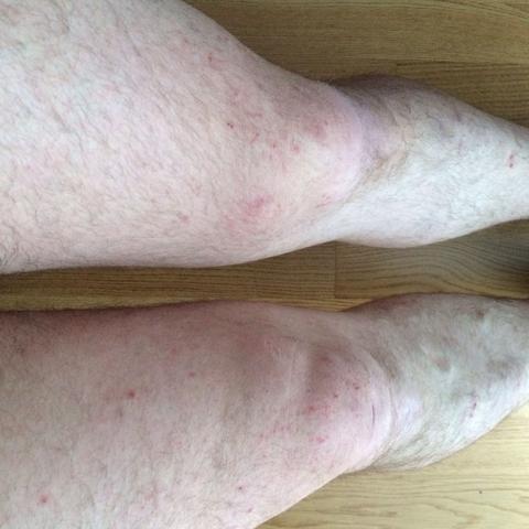 Ausschlag? - (Allergie, Ausschlag)