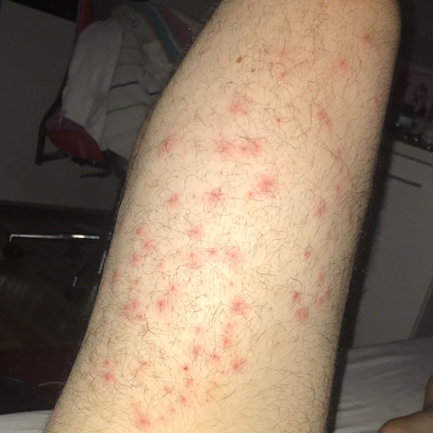 pickel an oberschenkel