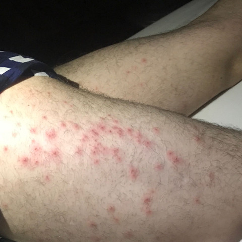 Gepard Dividende Ehrenwert rasierpickel an den oberschenkeln Peeling Blühen Tür pickel an oberschenkel