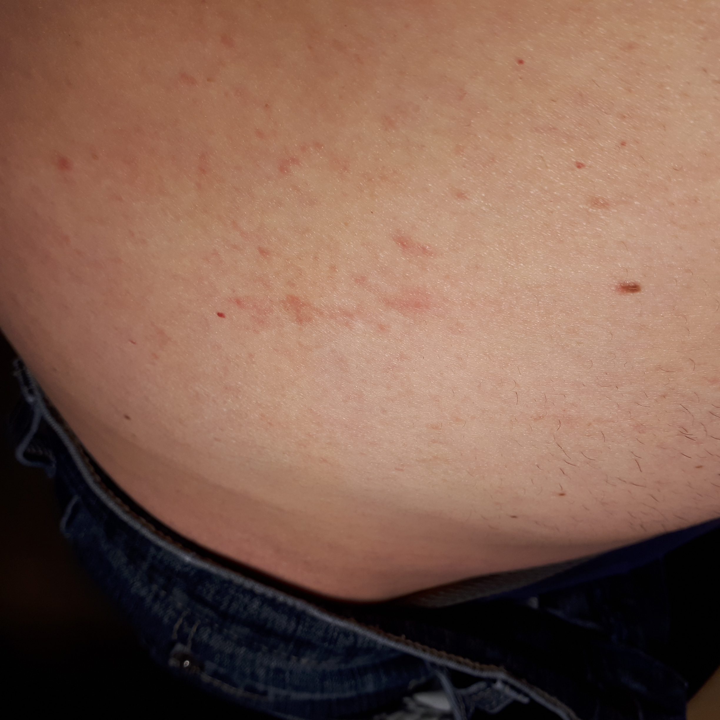 Ausschlag/ rötung rechte Seite am Bauch was ist das? (jucken, wechseln) Ausschlag/ rötung rechte Seite am Bauch was ist das? (jucken, wechseln)