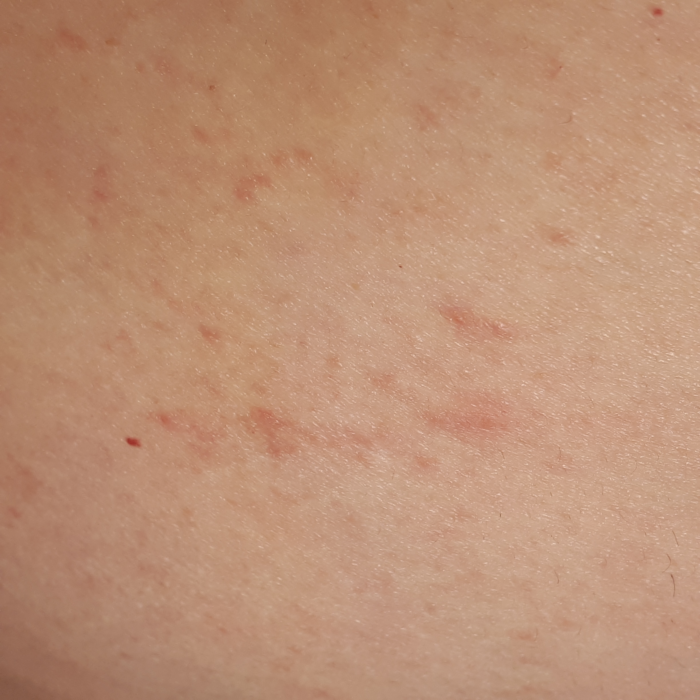 Ausschlag/ rötung rechte Seite am Bauch was ist das? (jucken, wechseln) Ausschlag/ rötung rechte Seite am Bauch was ist das? (jucken, wechseln)