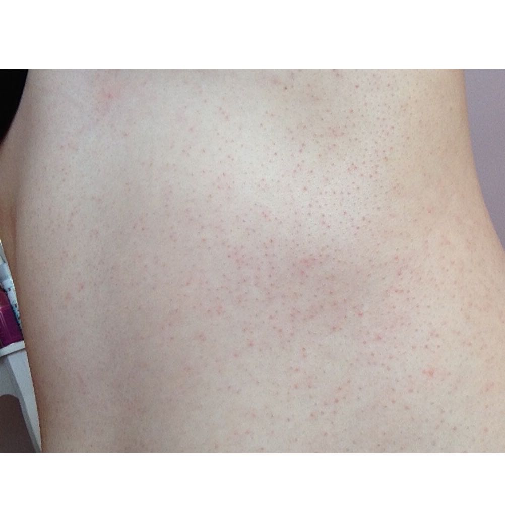 Ausschlag rote kleine Punkte auf komplettem Bauch was könnte das sein ...