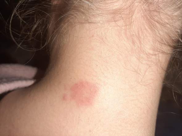 Ausschlag Standig Auf Dem Rucken Gesundheit Und Medizin Haut Ausschlag Standig Auf Dem Rucken Gesundheit Und Medizin Haut