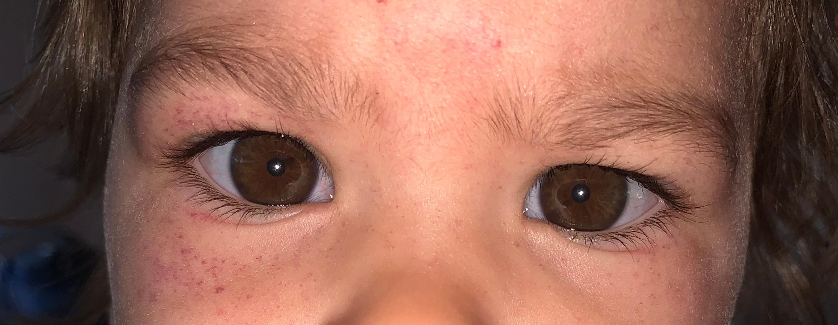 Ausschlag Um Die Augen Kleines Kind Was Ist Das Gesundheit Und Medizin Krankheit Kinder Ausschlag Um Die Augen Kleines Kind Was Ist Das Gesundheit Und Medizin Krankheit Kinder