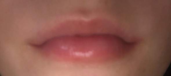 Ausschlag Um Die Lippen Rote Umrandung Gesundheit Und Medizin Schmerzen Brennen