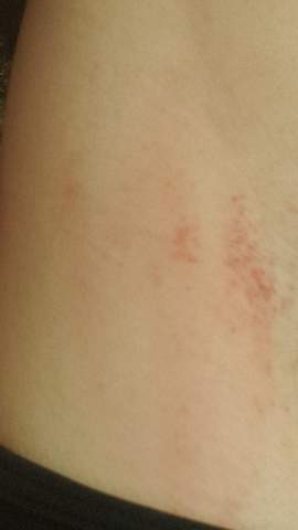 Ausschlag Und Jucken Am Ganzen Korper Gesundheit Und Medizin Haut Ausschlag Und Jucken Am Ganzen Korper Gesundheit Und Medizin Haut