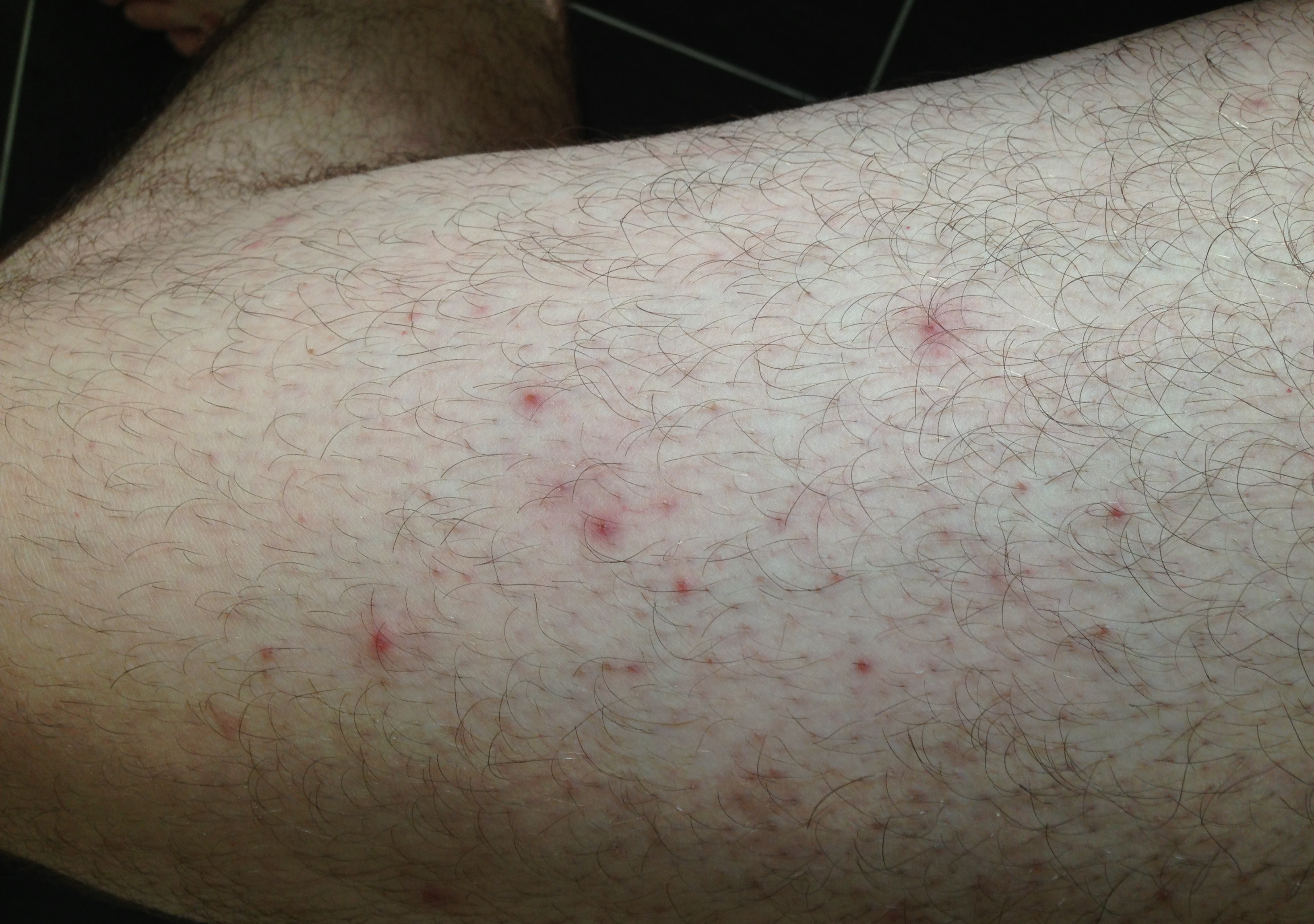 Ausschlag Und Pickel Ein Anzeichen Fur Eine Hiv Infektion Krankheit Geschlechtsverkehr Aids