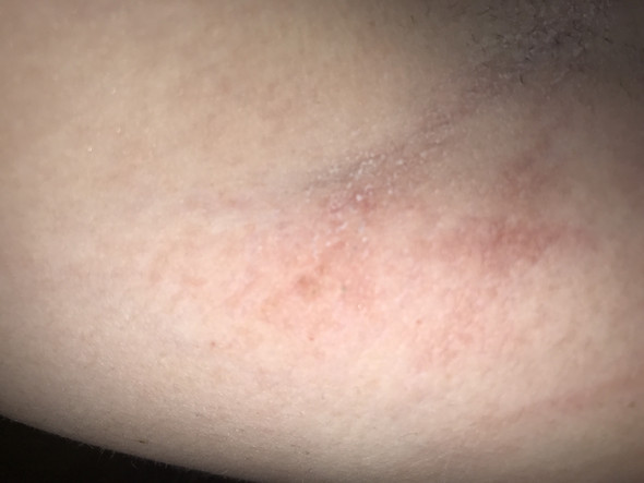 Ausschlag Unter An Achseln Gesundheit Ausschlag Unter An Achseln Gesundheit
