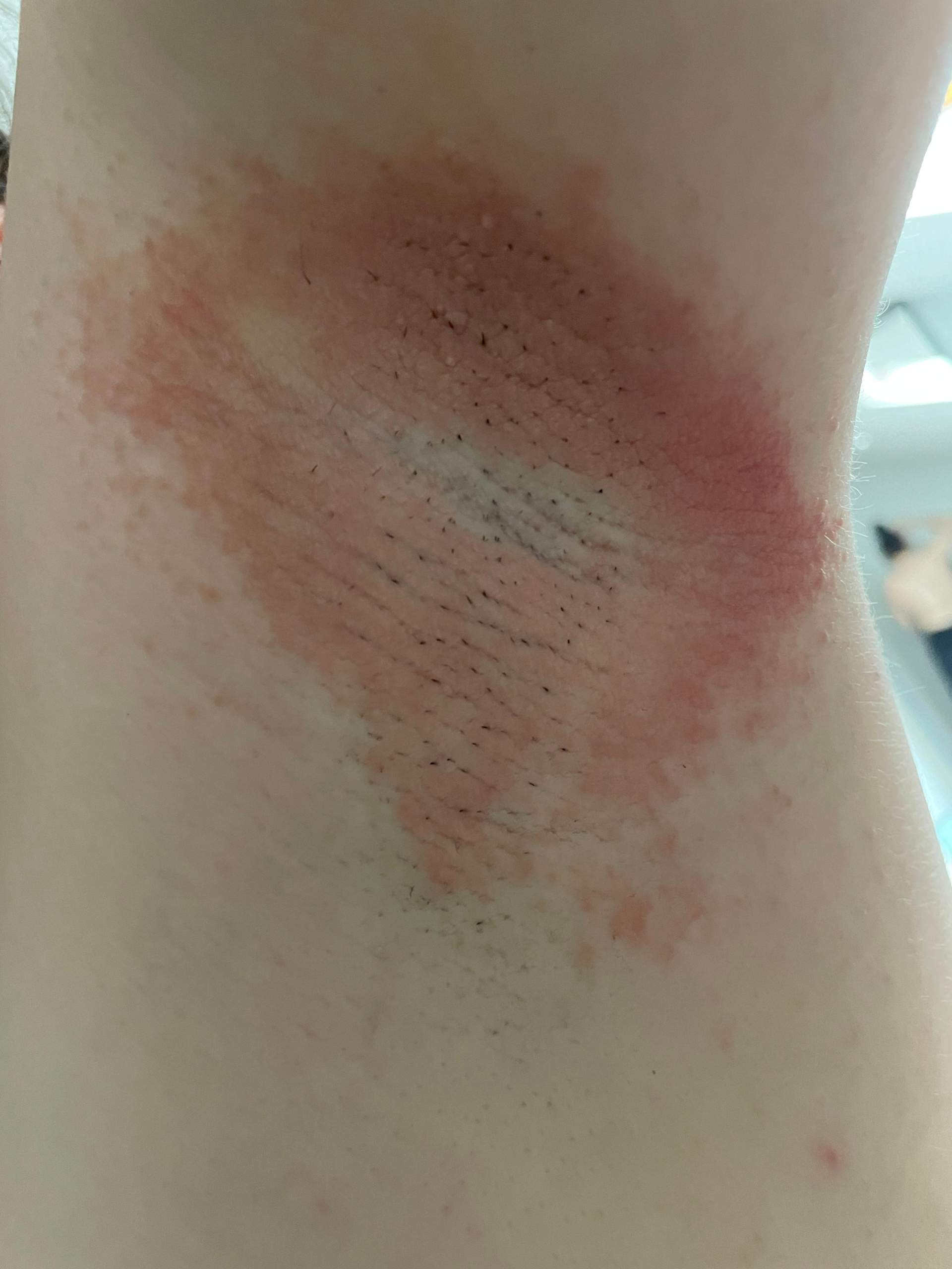 Ausschlag unter den Achseln? (Gesundheit und Medizin, Haut, rasieren)