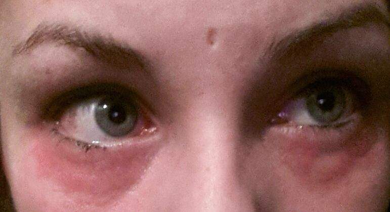 Ausschlag unter den Augen, sowie auf dem Lid
