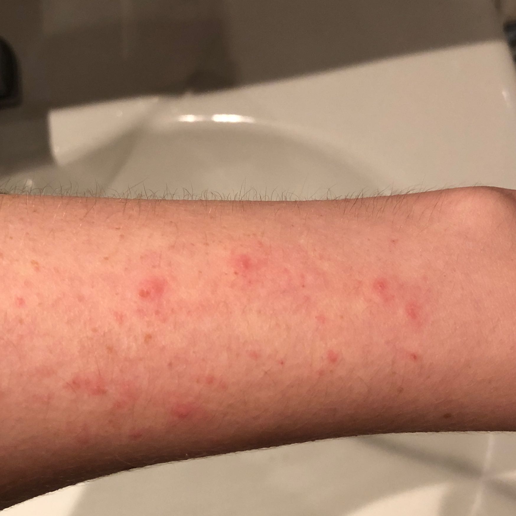 Ausschlag/Allergie auf Arm? (Gesundheit und Medizin, Haut, Juckreiz)