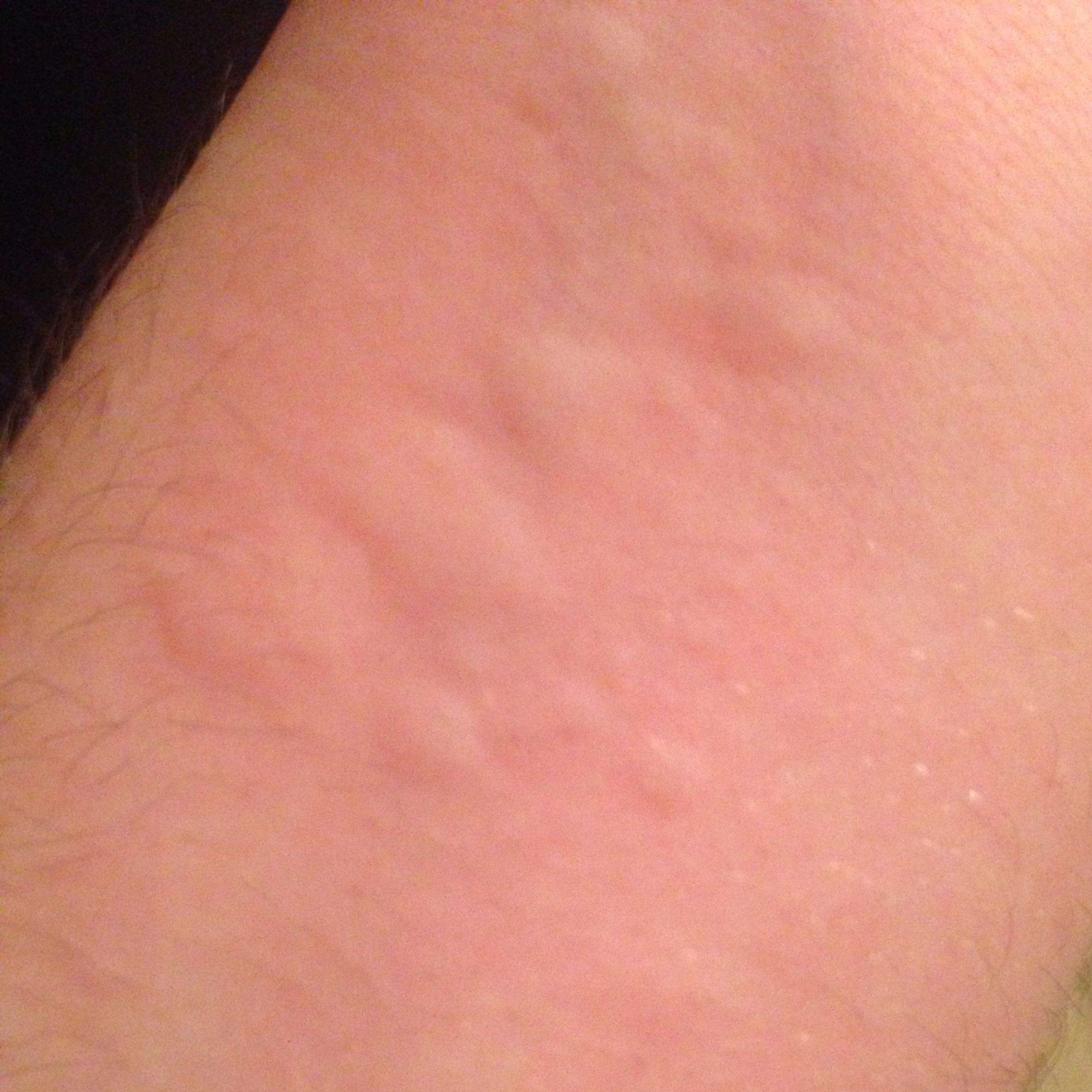 Ausschlag/Allergie? Hilfe? (Arzt, Haut, jucken) Ausschlag/Allergie? Hilfe? (Arzt, Haut, jucken)