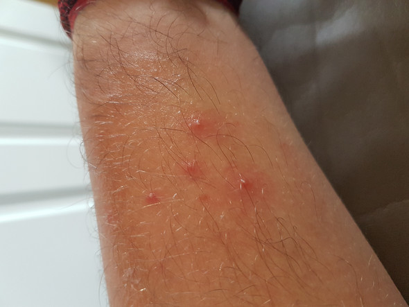 pickel an der wirbelsäule pickel an der wirbelsäule