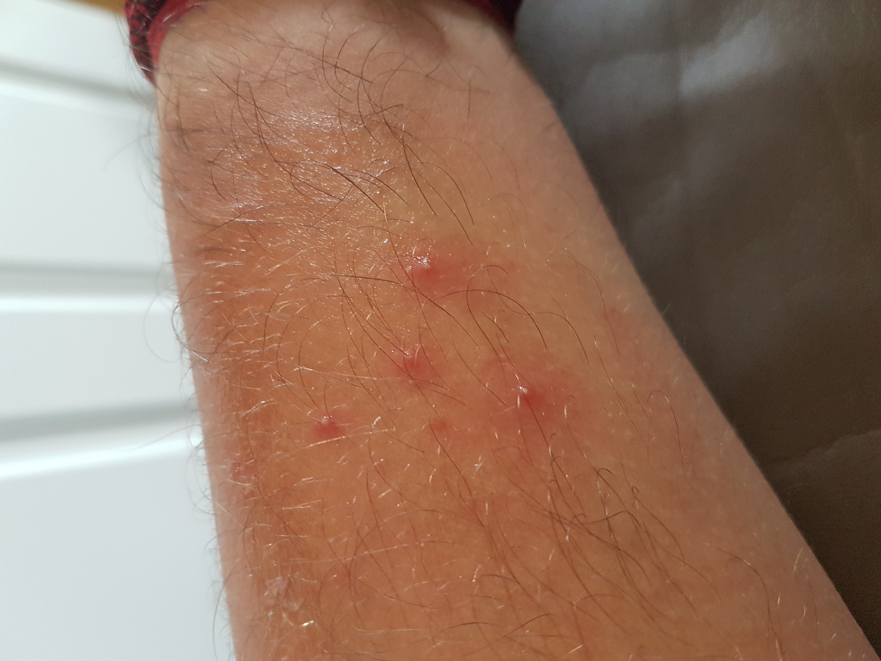 Ausschlag/Pickel an beiden Unterarmen? Jetzt auch mit Photo :-)? (Gesundheit, Gesundheit und pickel auf der hand