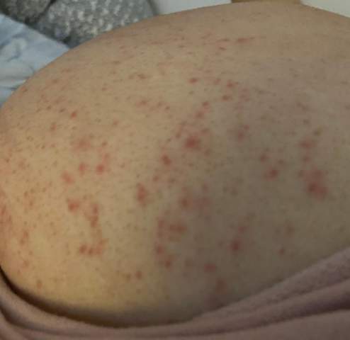 Ausschlag Schmerzende Pickel Am Po 17 Jahre Gesundheit Und Medizin Gesundheit Madchen Ausschlag Schmerzende Pickel Am Po 17 Jahre Gesundheit Und Medizin Gesundheit Madchen