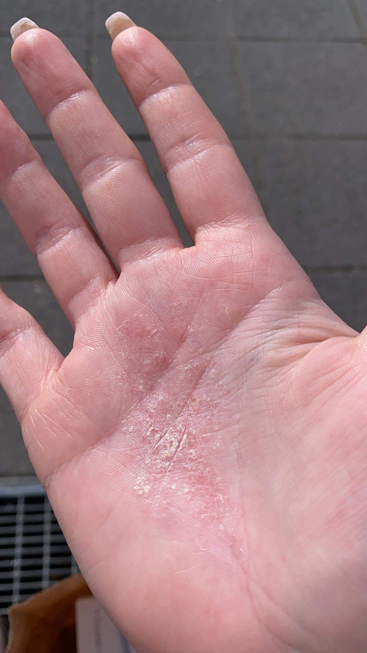 Ausschlag?Schuppige Handinnenflächen? (Gesundheit und Medizin, Haut)