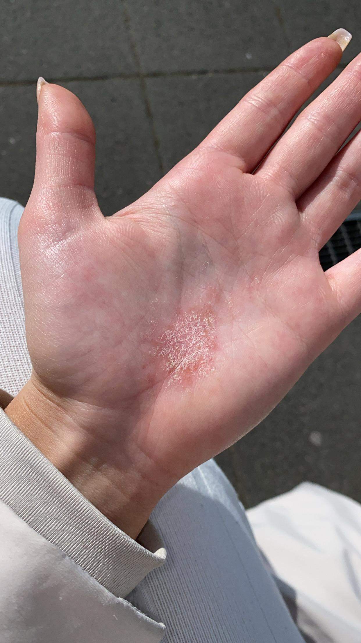 Ausschlag?Schuppige Handinnenflächen? (Gesundheit und Medizin, Haut)