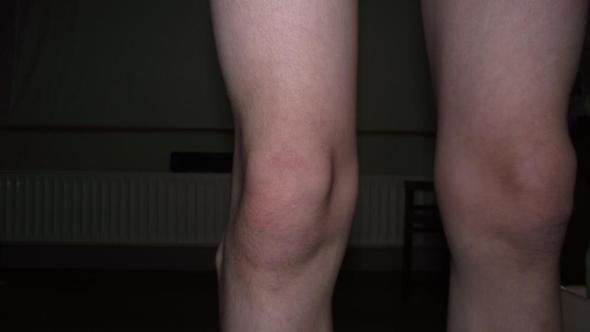 Aussen An Den Knien Ragen Knochen Heraus Aussen An Den Knien Ragen Knochen Heraus