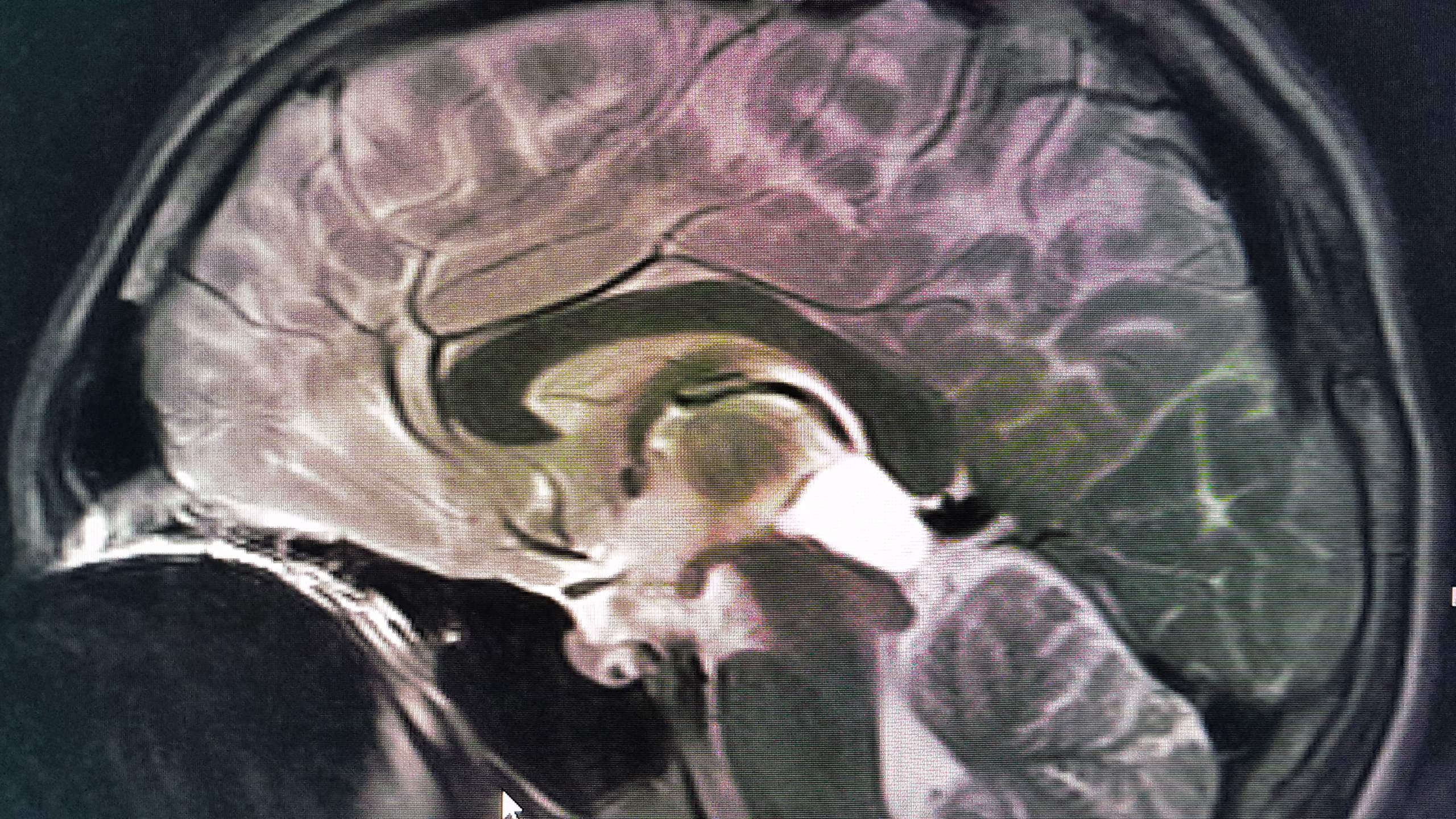 Auswertung Schädel-MRT? (Medizin)