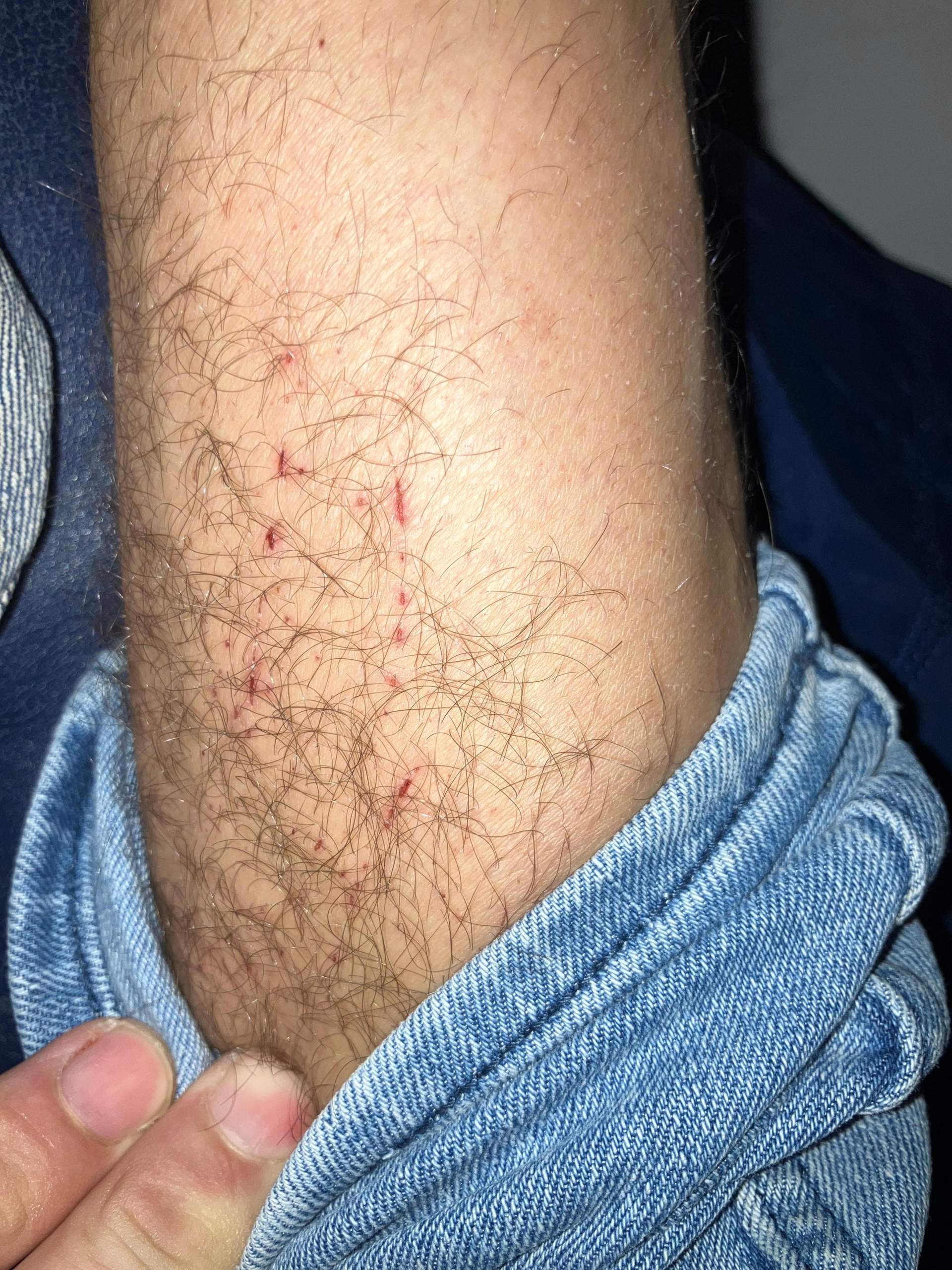 aWas sind ds für. Stichel? (Schmerzen, Füße, Entzündung)