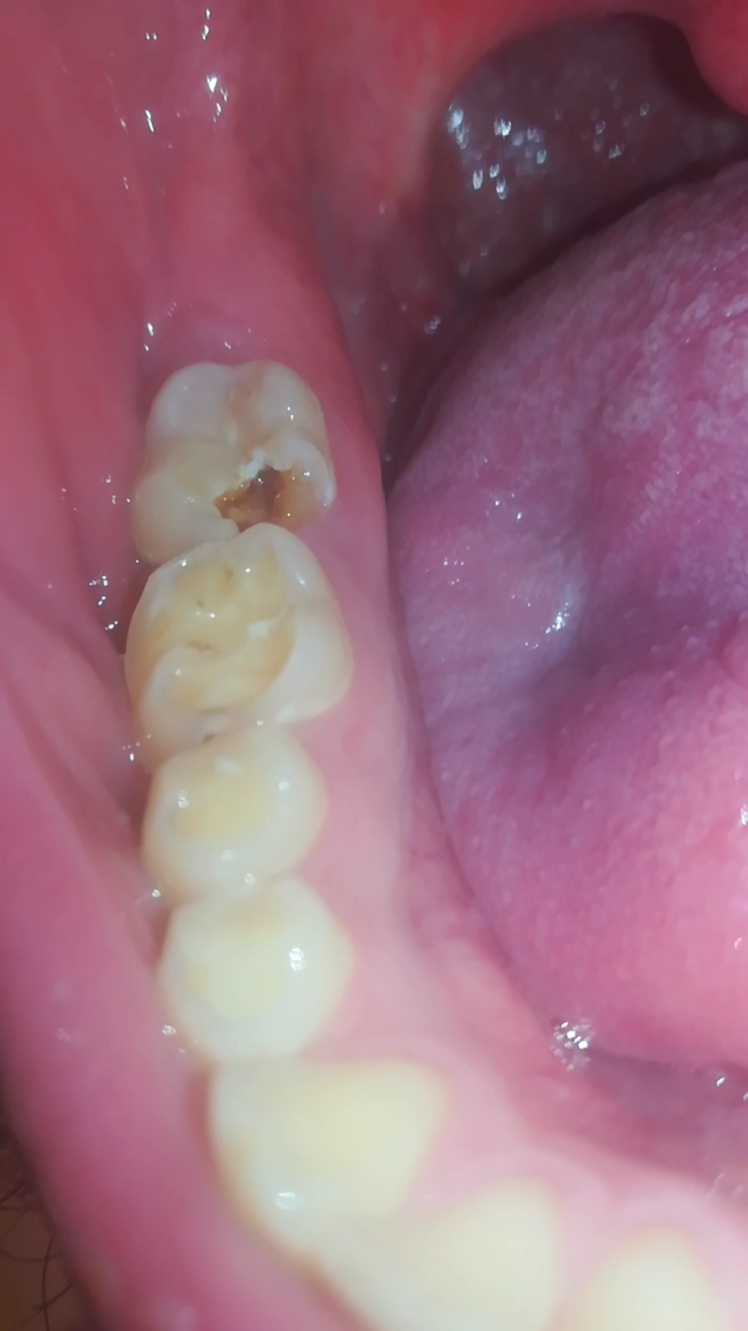 Backenzahn großes Stück abgebrochen Wurzel liegt frei? (ACHTUNG BILD)? (Gesundheit und Medizin Backenzahn großes Stück abgebrochen Wurzel liegt frei? (ACHTUNG BILD)? (Gesundheit und Medizin