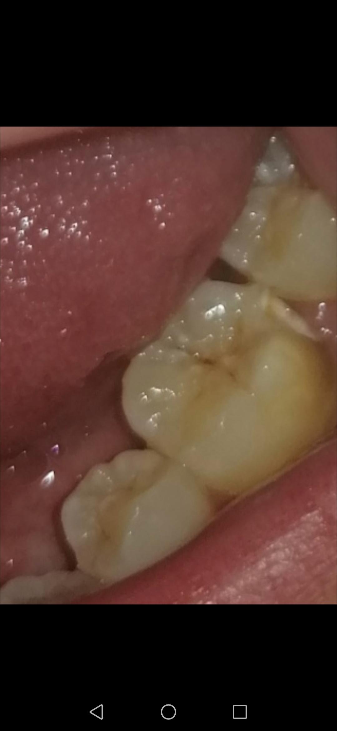 Zahn Abgebrochen Zahn Abgebrochen Behandlung Und Kosten 2020 08 07