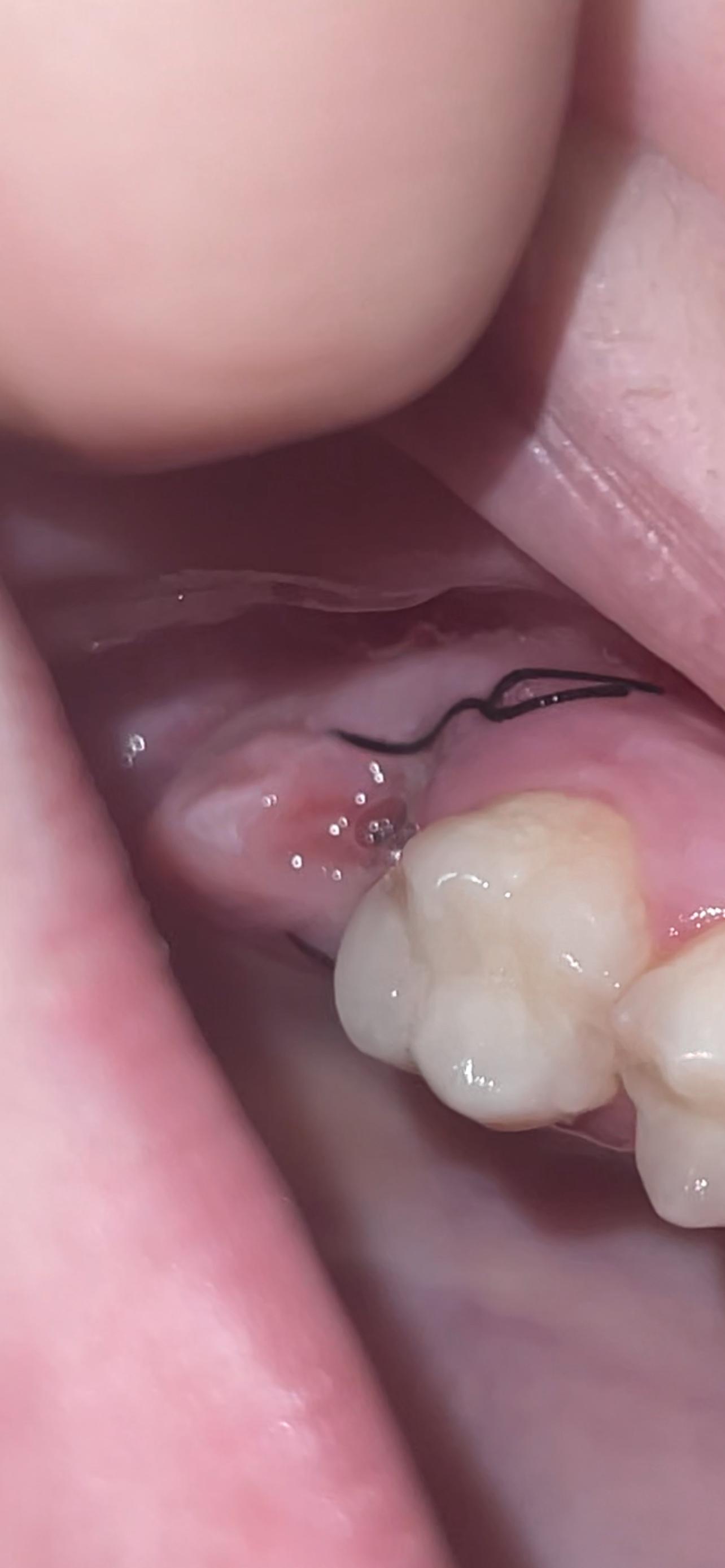 Zahn Gezogen Rauchen Kaffee