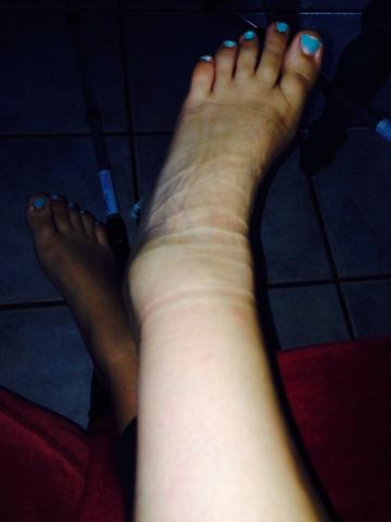 Banderdehnung Oder Banderriss Banderdehnung Oder Banderriss