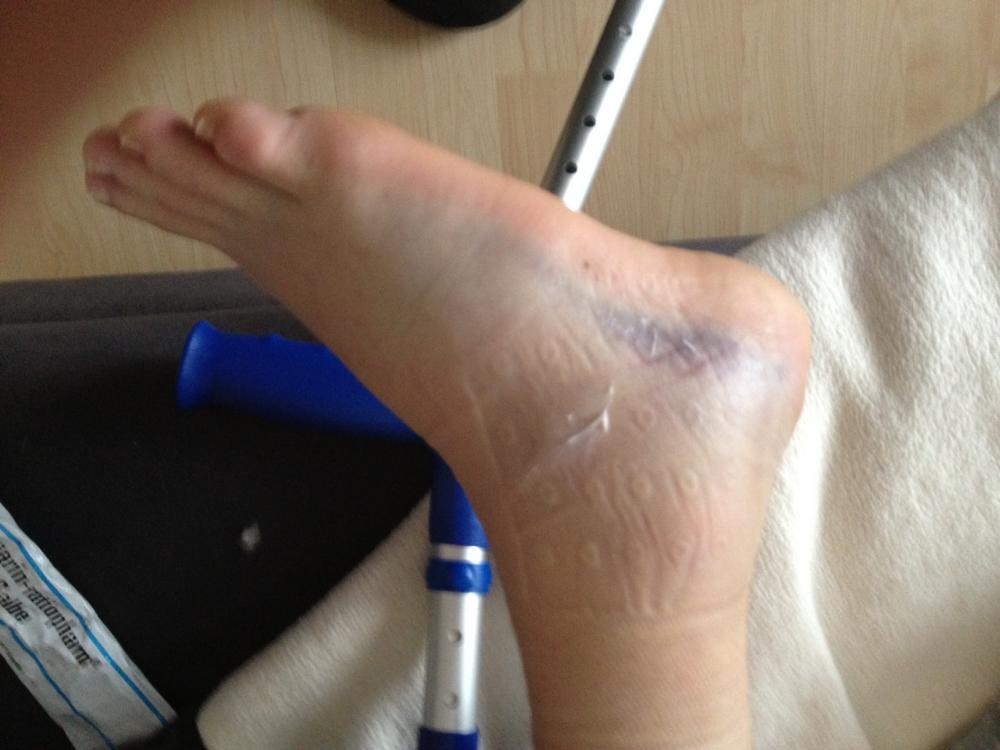 bänderriss nach arbeitsunfall (Medizin) stützstrumpf bänderriss