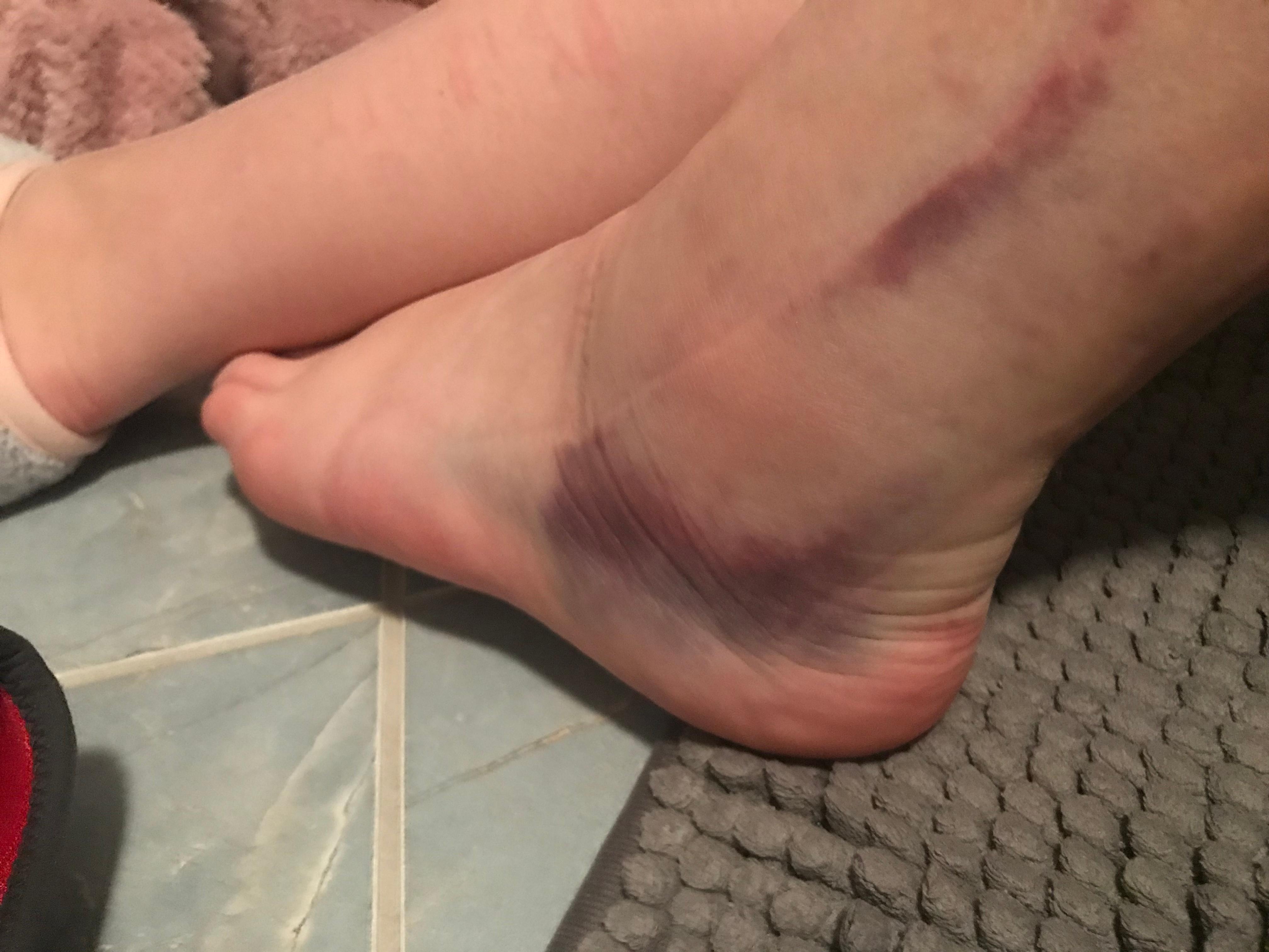 Banderriss Nicht Erkannt Gesundheit Und Medizin Prellung