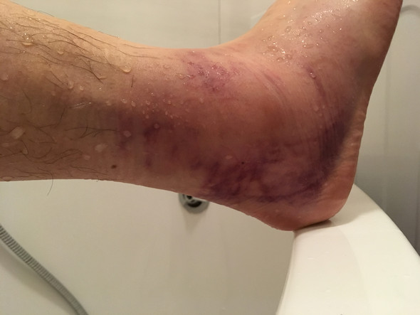 Banderriss Oder Banderdehnung Soll Ich Es Belasten Banderriss Oder Banderdehnung Soll Ich Es Belasten