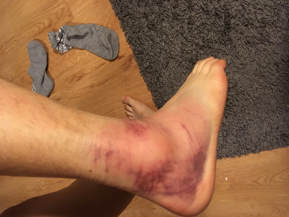 Banderriss Oder Banderdehnung Soll Ich Es Belasten Banderriss Oder Banderdehnung Soll Ich Es Belasten