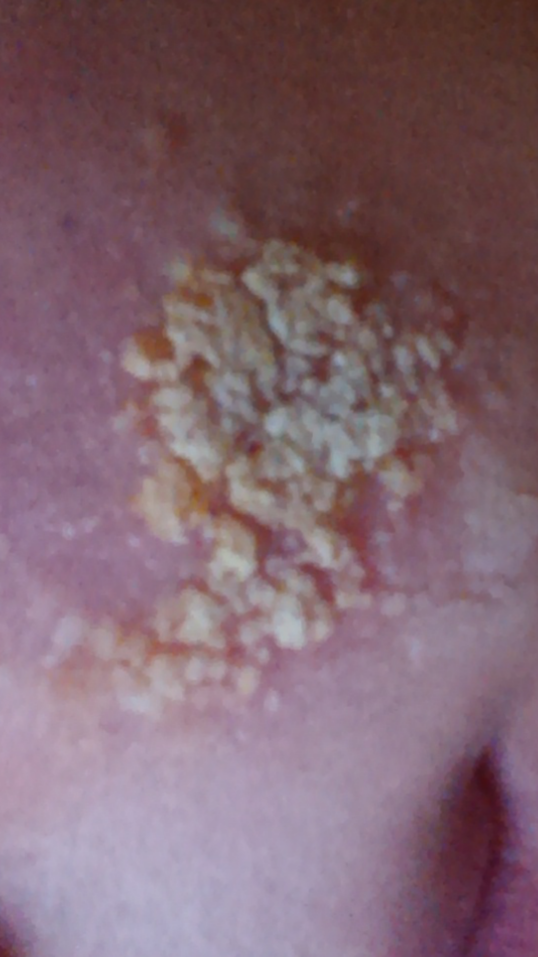 Bakterielle Hautinfektion?! (Haut, Infektion)