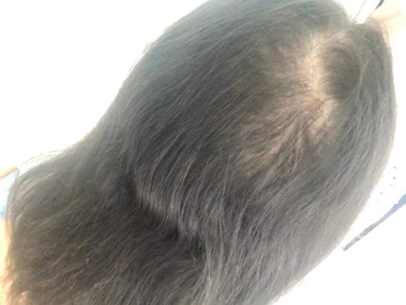 keine haare mehr auf dem kopf