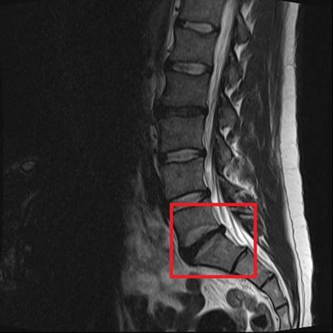 Bandscheibenvorfall Ruckenschmerzen Bandscheibe Ruckenprobleme Bandscheibenvorfall Ruckenschmerzen Bandscheibe Ruckenprobleme