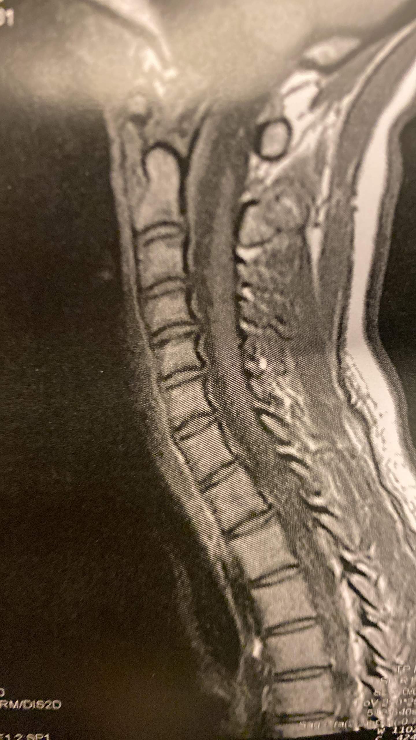 Bandscheibenvorfall HWS? (Gesundheit, Medizin, Rücken)