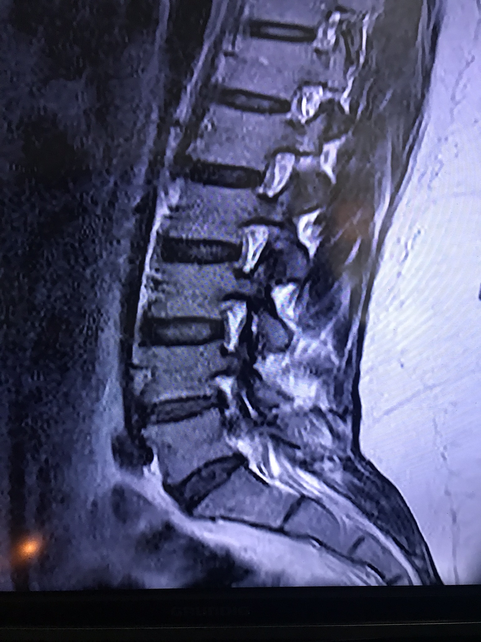 Bandscheibenvorfall? Sieht man was im MRT? (Rückenschmerzen, LWS) Bandscheibenvorfall? Sieht man was im MRT? (Rückenschmerzen, LWS)