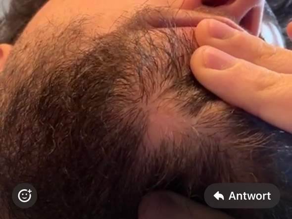 - (Haare, Hautarzt, Haarausfall)