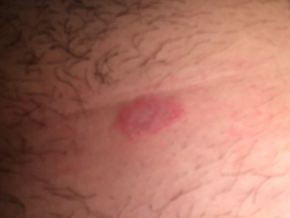 Bauch Ausschlag Gesundheit Und Medizin Pickel Bauch Ausschlag Gesundheit Und Medizin Pickel