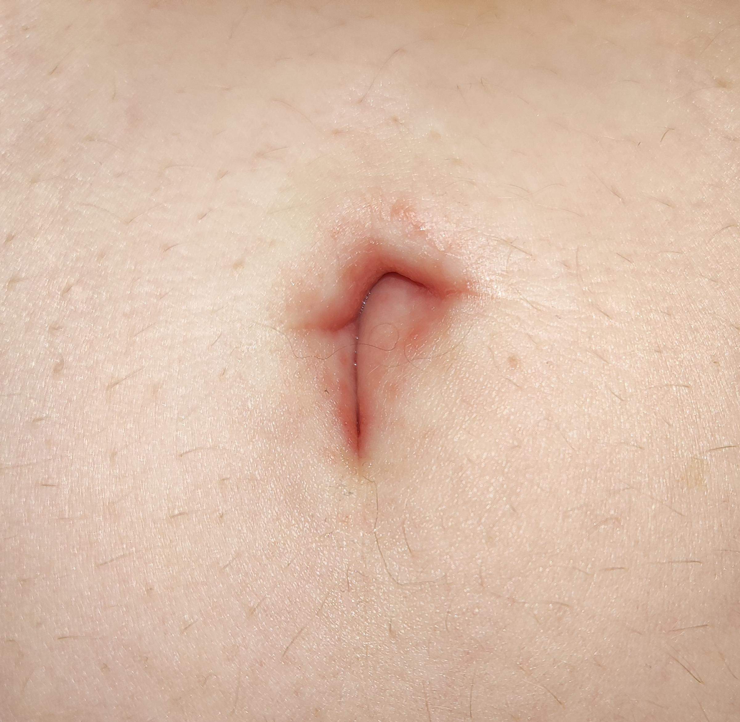 Behandlungsmöglichkeiten für einen stinkenden Bauchnabel Behandlungsmöglichkeiten für einen stinkenden Bauchnabel