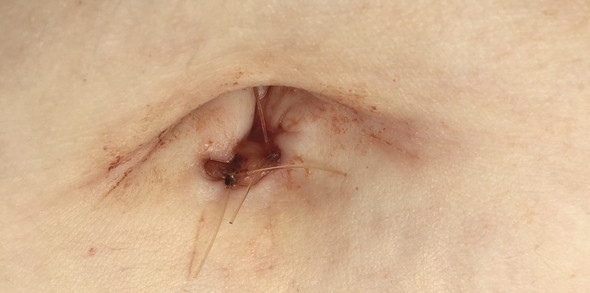 Bauchnabel Nach Laraskopie Normal Gesundheit Und Medizin Op Gynakologie Bauchnabel Nach Laraskopie Normal Gesundheit Und Medizin Op Gynakologie