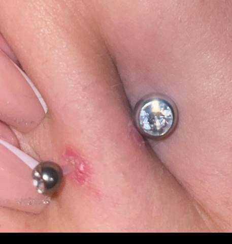 bauchnabel piercing trotz tyrosur gel entzündet?