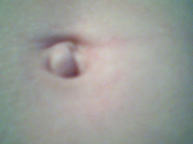 Bauchnabel schmerzt dauernd, veralteter nabelbruch? (Schmerzen) Bauchnabel schmerzt dauernd, veralteter nabelbruch? (Schmerzen)