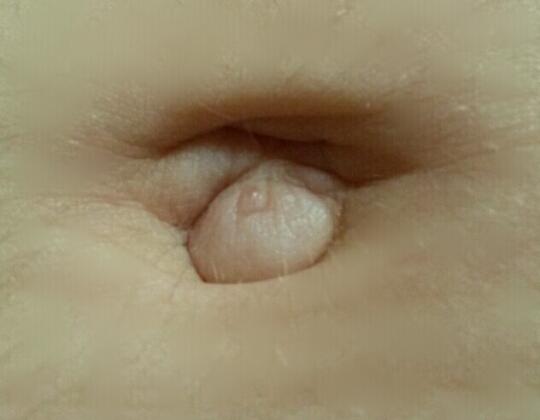 Bauchnabelbruch Oder Eher Nicht Bruch Untersuchung Bauchnabel Bauchnabelbruch Oder Eher Nicht Bruch Untersuchung Bauchnabel