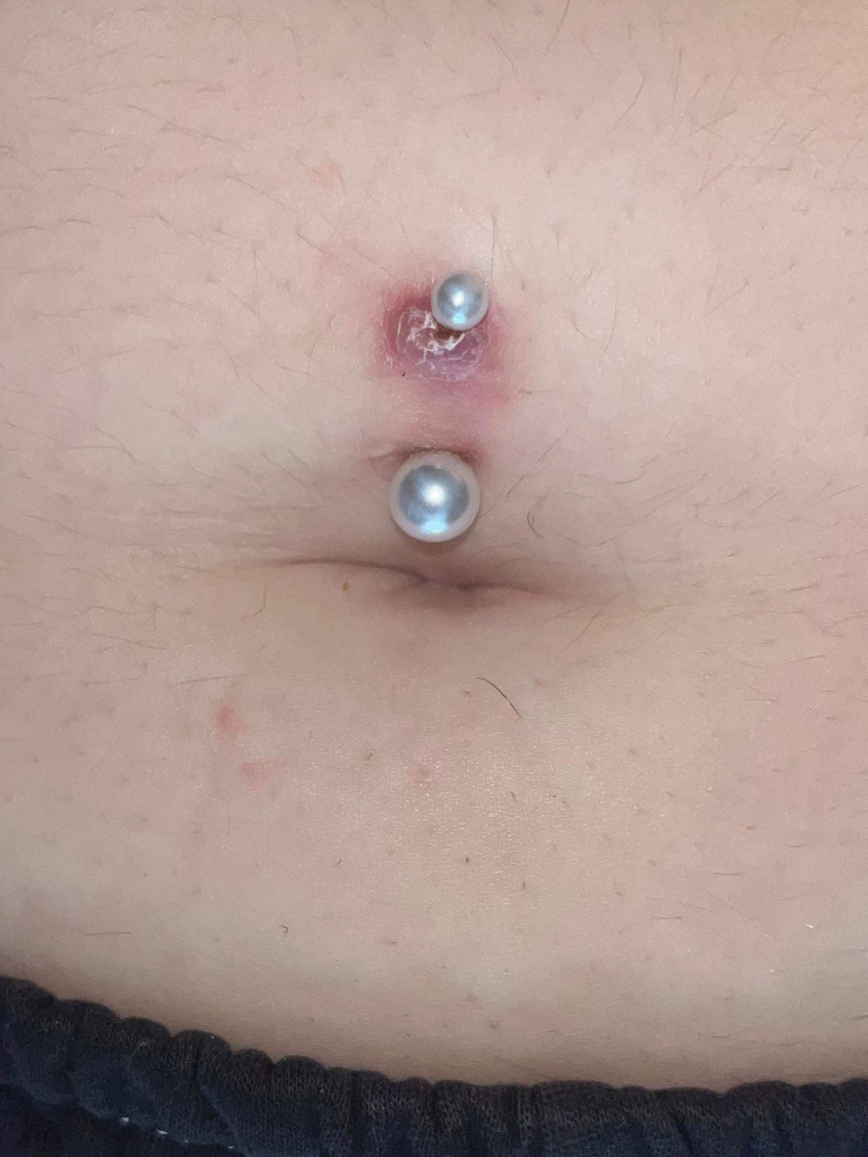 Bauchnabelpiercing Entz ndet Oder Allergie Entz ndung K rperschmuck Bauchnabelpiercing Entz ndet Oder Allergie Entz ndung K rperschmuck