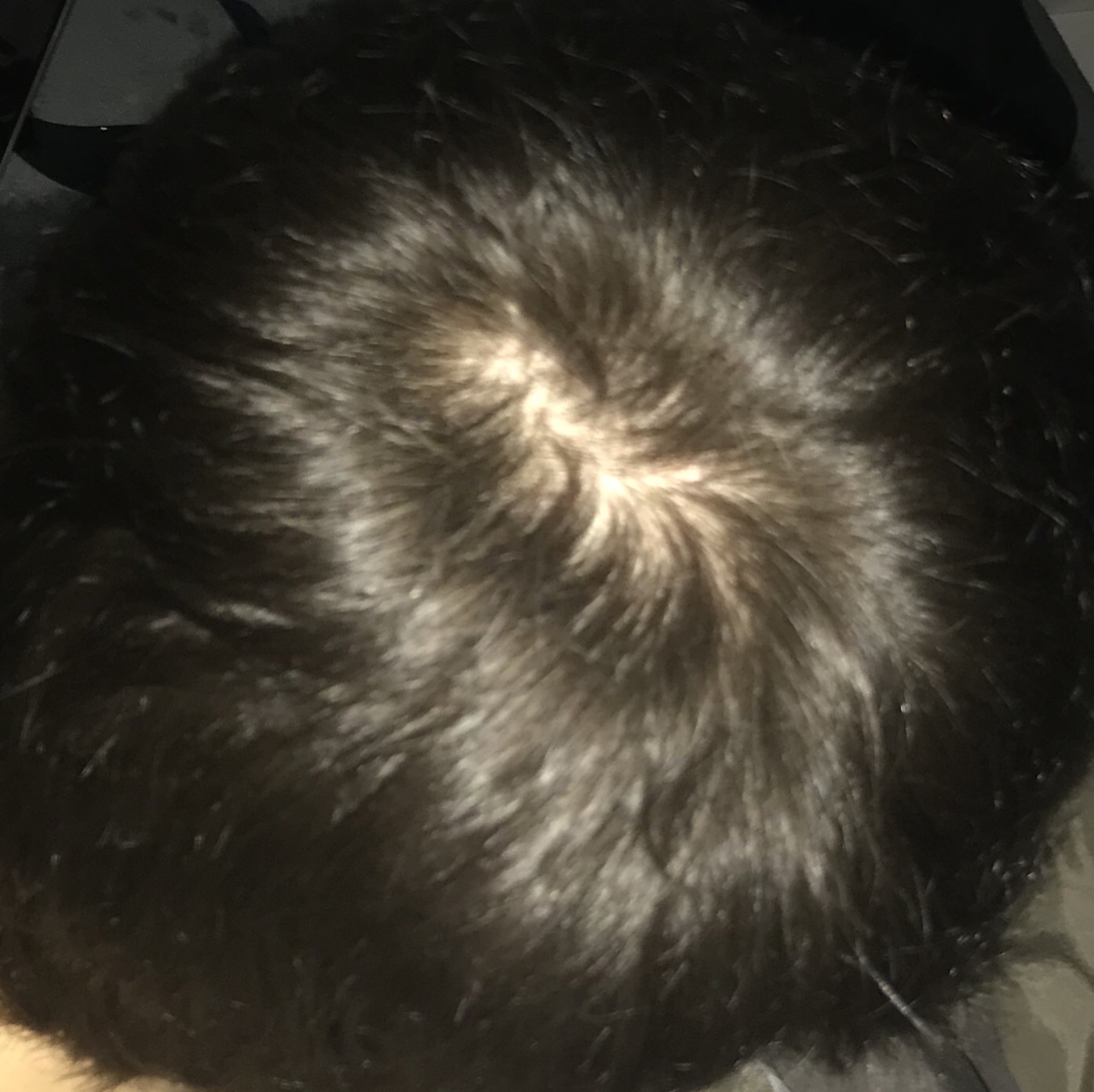 Wie Bekommt Man Einen Wirbel Im Haar Weg Beginn von Haarausfall oder Haarwirbel? (Haare, Haarpflege, haarwuchs)